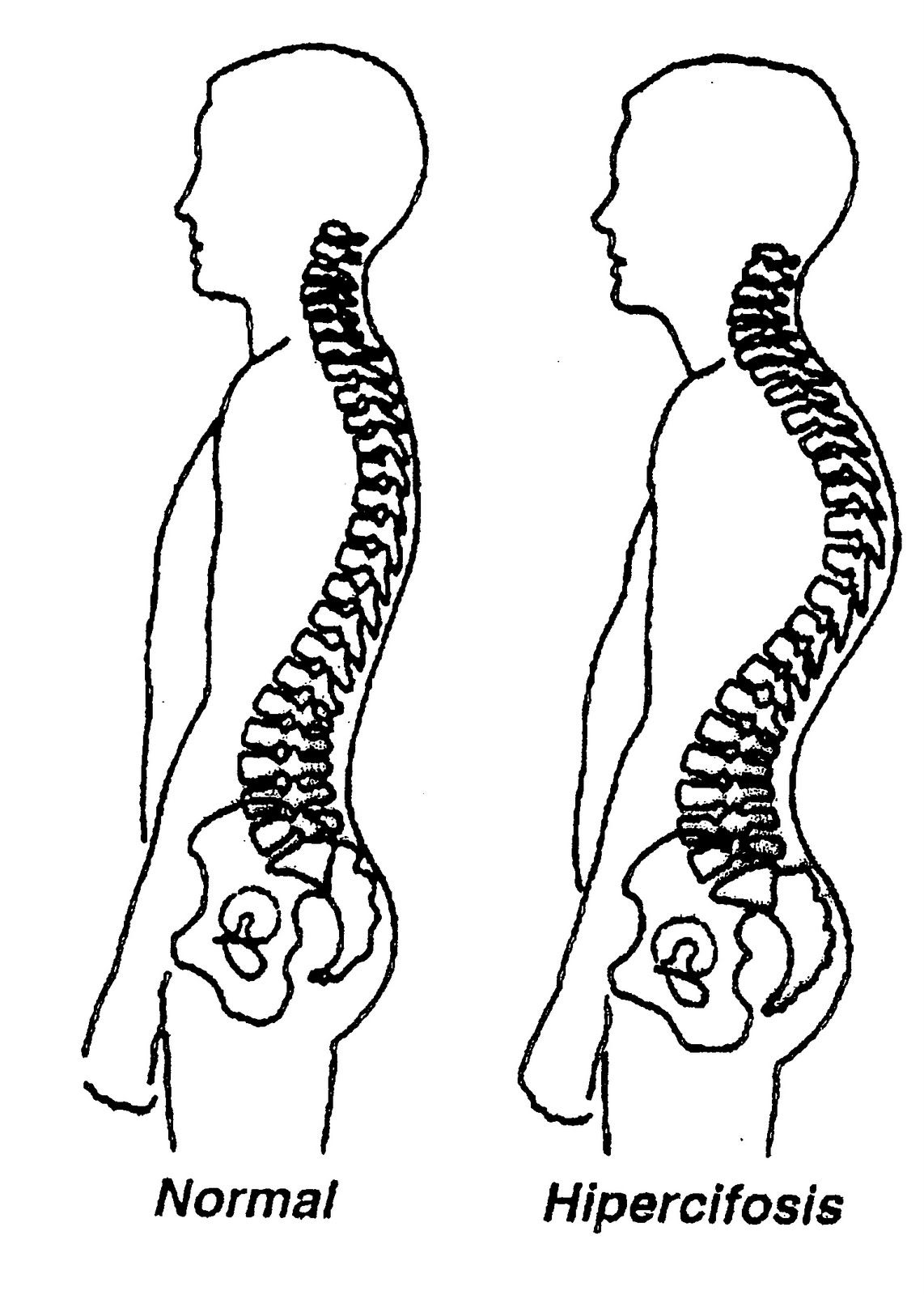hipercifosis