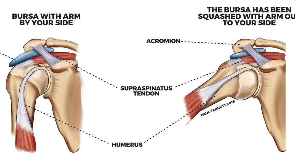 impingement subacromial