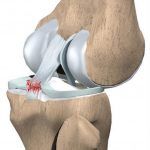 rotura del ligamento cruzado anterior